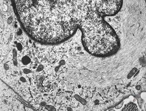 F, 49y. | myelosarcoma … histiocyte-like cells in dermal infiltrates F, 49y. | myelosarcoma … histiocyte-like cells in dermal infiltrates